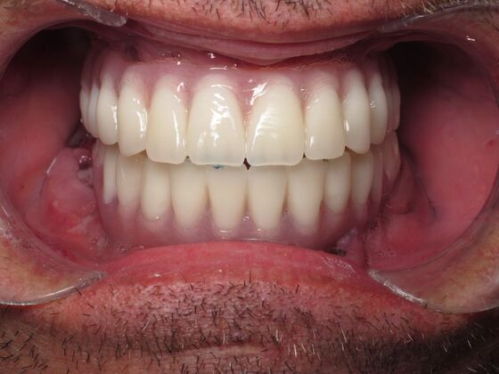 Full Mouth Implants: Immediate Upper and Lower Implants After Tooth Loss, Bone Loss, and Staining - Immediate Temporary