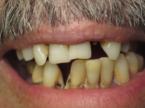 Full Mouth Implants: 10-Year Full-Mouth Implant Result That Still Feels Natural - Before