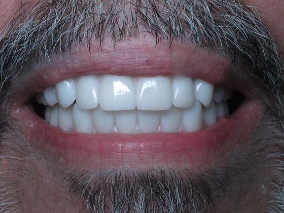 Full Mouth Implants: 10-Year Full-Mouth Implant Result That Still Feels Natural - After