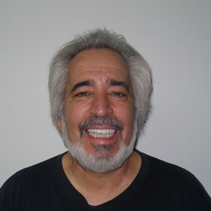 Full Mouth Implants: A 10-Year Full-Mouth Implant Result That Still Feels Natural - 2016 Result