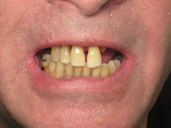 Full Mouth Implants: Full-Mouth Implants for Severely Decayed, Eroded, and Missing Teeth - Before