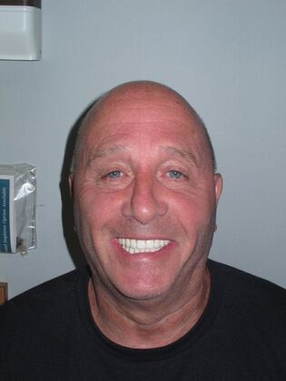 Full Mouth Implants: Full-Mouth Implants for Severely Decayed, Eroded, and Missing Teeth - After