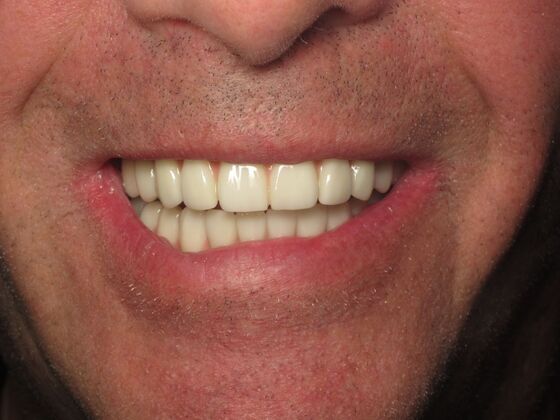 Full Mouth Implants: Full-Mouth Implants for Severely Decayed, Eroded, and Missing Teeth - After