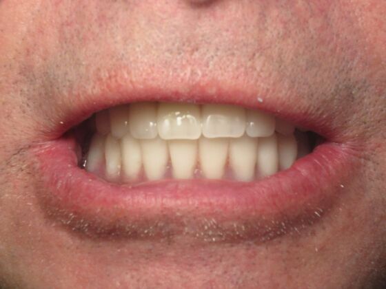 Full Mouth Implants: Full-Mouth Implants for Severely Decayed, Eroded, and Missing Teeth - Immediate Temporary