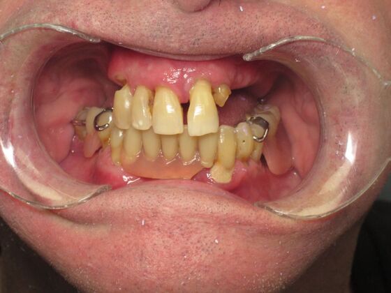 Full Mouth Implants: Full-Mouth Implants for Severely Decayed, Eroded, and Missing Teeth - Before