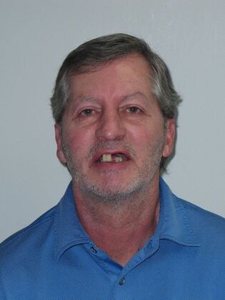 Full Mouth Implants Full-Mouth Implants After Missing Front Teeth and Severe Breakdown - Before