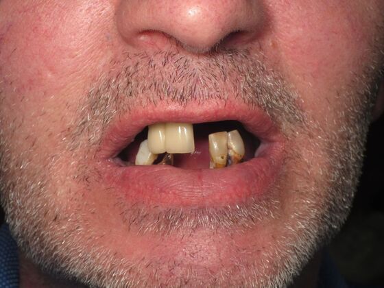 Full Mouth Implants: Full-Mouth Implants for Missing Front Teeth and Severe Dental Breakdown - Before