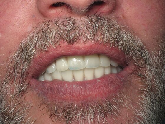 Full Mouth Implants: Full-Mouth Implants for Missing Front Teeth and Severe Dental Breakdown - After