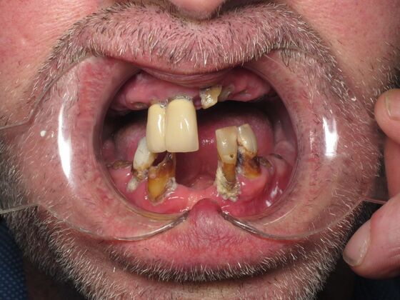 Full Mouth Implants: Full-Mouth Implants for Missing Front Teeth and Severe Dental Breakdown - Before