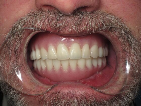 Full Mouth Implants: Full-Mouth Implants for Missing Front Teeth and Severe Dental Breakdown - After