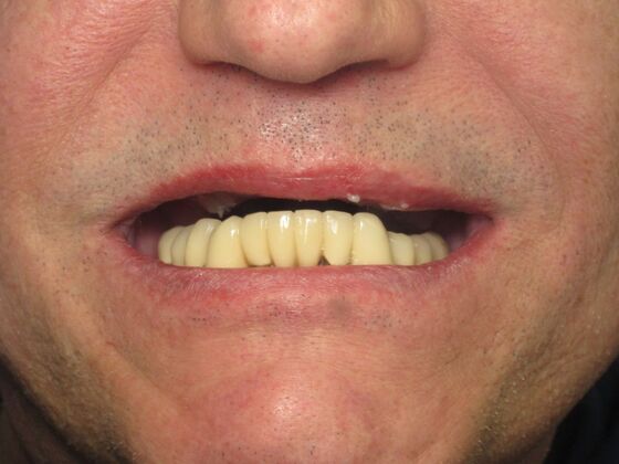 Full Mouth Implants: Full-Mouth Implants for Failing Bridges, Comfort, and Function - Before