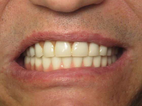Full Mouth Implants: Full-Mouth Implants for Failing Bridges, Comfort, and Function - After