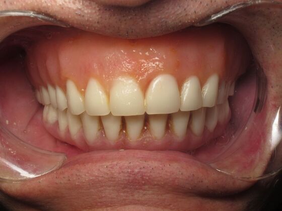 Full Mouth Implants: Full-Mouth Implants for Failing Bridges, Comfort, and Function - After