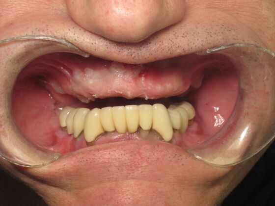 Full Mouth Implants: Full-Mouth Implants for Failing Bridges, Comfort, and Function - Before
