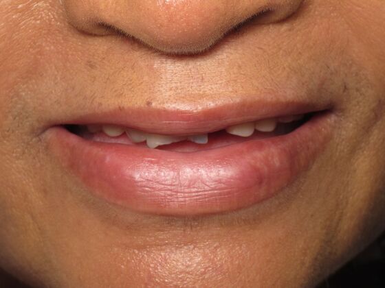 Full Mouth Implants: Full Mouth Implants After Dentures, Fear, and Hiding Her Smile - Before