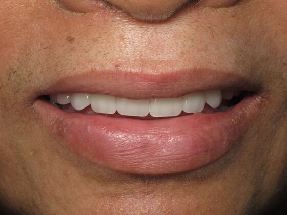 Full Mouth Implants: Full Mouth Implants After Dentures, Fear, and Hiding Her Smile - After