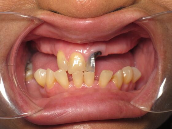 Full Mouth Implants: Full Mouth Implants After Dentures, Fear, and Hiding Her Smile - Before