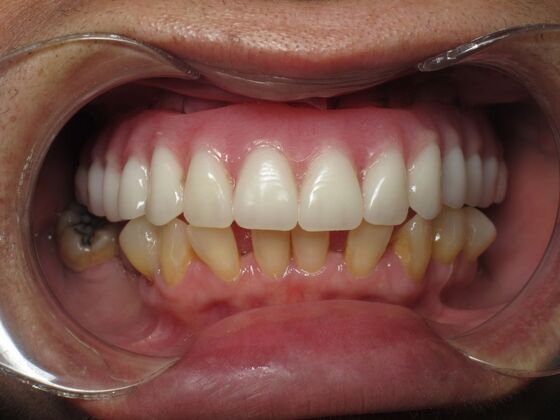 Full Mouth Implants: Full Mouth Implants After Dentures, Fear, and Hiding Her Smile - After