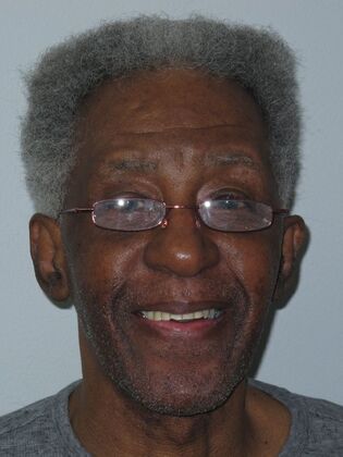 Full Mouth Implants Almond’s Fixed Smile After Missing Front Teeth and Partial Denture Worry - After