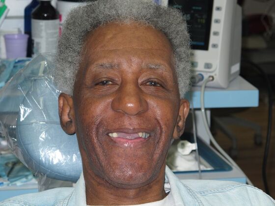Full Mouth Implants: Full Mouth Implants After Missing Front Teeth and Partial Denture Worry - Before