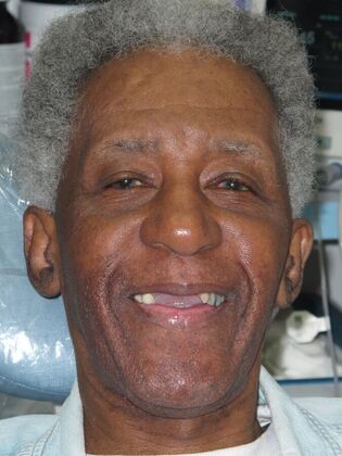 Full Mouth Implants Almond’s Fixed Smile After Missing Front Teeth and Partial Denture Worry - Before