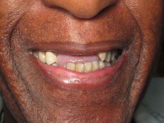 Full Mouth Implants: Full Mouth Implants After Missing Front Teeth and Partial Denture Worry - Before