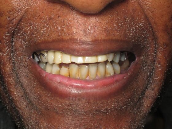 Full Mouth Implants: Full Mouth Implants After Missing Front Teeth and Partial Denture Worry - After