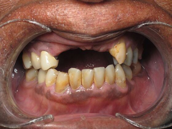 Full Mouth Implants: Full Mouth Implants After Missing Front Teeth and Partial Denture Worry - Before
