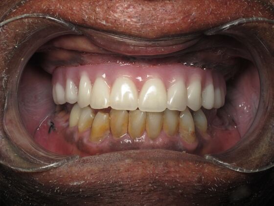 Full Mouth Implants: Full Mouth Implants After Missing Front Teeth and Partial Denture Worry - After