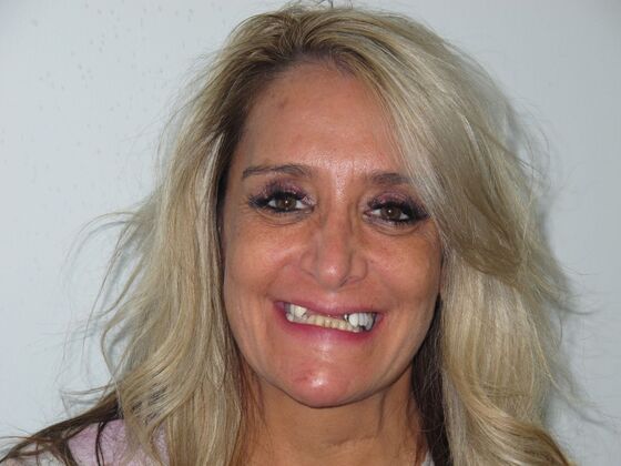 Full Mouth Implants: Full Mouth Implants for Severe Tooth Loss and a Confident Smile - Before