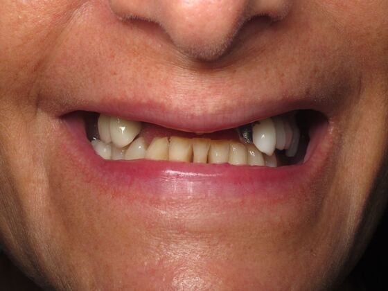 Full Mouth Implants: Full Mouth Implants for Severe Tooth Loss and a Confident Smile - Before