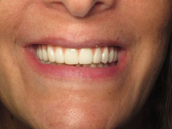 Full Mouth Implants: Full Mouth Implants for Severe Tooth Loss and a Confident Smile - After