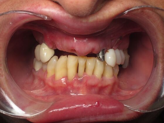 Full Mouth Implants: Full Mouth Implants for Severe Tooth Loss and a Confident Smile - Before