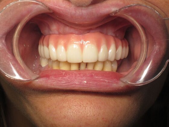 Full Mouth Implants: Full Mouth Implants for Severe Tooth Loss and a Confident Smile - After