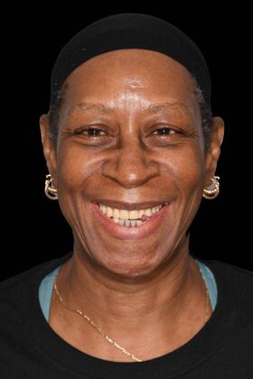 Full Mouth Implants: Full Mouth Implants After Dental Pain, Anxiety, and a Broken Partial - Before