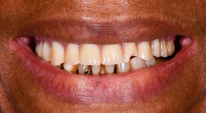 Full Mouth Implants: Full Mouth Implants After Dental Pain, Anxiety, and a Broken Partial - Before