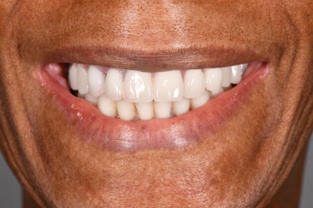 Full Mouth Implants: Full Mouth Implants After Dental Pain, Anxiety, and a Broken Partial - After