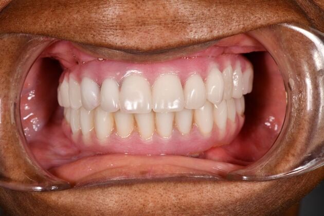 Full Mouth Implants: Full Mouth Implants After Dental Pain, Anxiety, and a Broken Partial - After