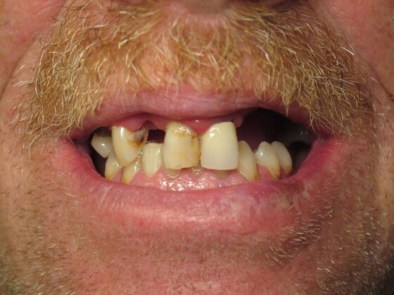Full Mouth Implants Upper Dental Implants After Missing Teeth, Bonds, and Crowns - Before