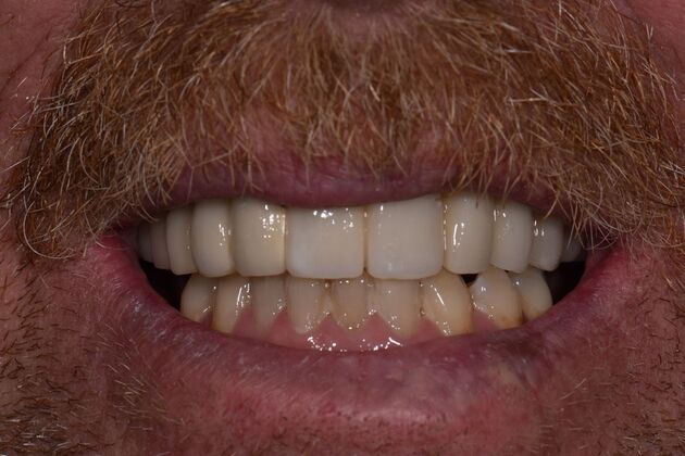 Full Mouth Implants Upper Dental Implants After Missing Teeth, Bonds, and Crowns - After