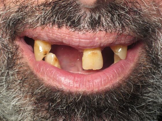 Full Mouth Implants: Full Mouth Implants After Tooth Loss, Jawbone Worry, and Hiding His Smile - Before