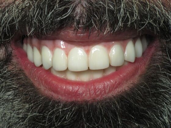 Full Mouth Implants: Full Mouth Implants After Tooth Loss, Jawbone Worry, and Hiding His Smile - After