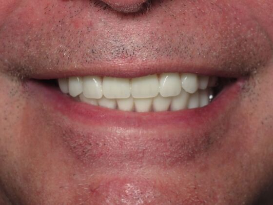 Full Mouth Implants: Full Arch Dental Implants After Bad Teeth and Self-Consciousness - After