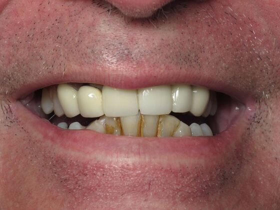 Full Mouth Implants: Full Arch Dental Implants After Bad Teeth and Self-Consciousness - Before