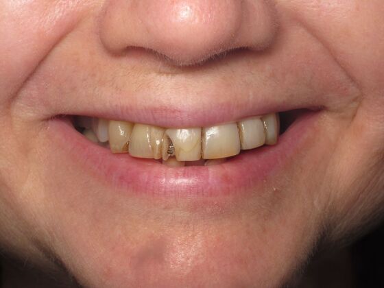 Cosmetic Crowns Cosmetic Crowns for Stained, Worn, and Uneven Front Teeth - Before