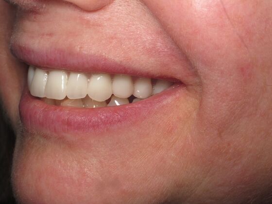Cosmetic Crowns: Cosmetic Crowns for Stained, Worn, and Uneven Front Teeth - After