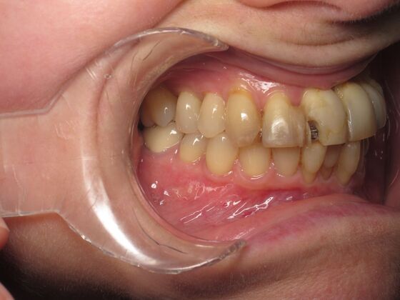 Cosmetic Crowns: Cosmetic Crowns for Stained, Worn, and Uneven Front Teeth - Before
