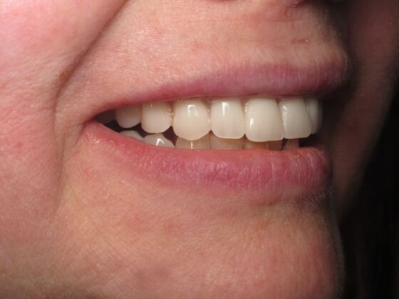 Cosmetic Crowns: Cosmetic Crowns for Stained, Worn, and Uneven Front Teeth - After