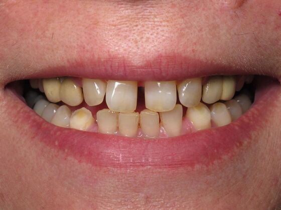 Cosmetic Crowns Cosmetic Crowns and Dental Implants for a Brighter Smile - Before