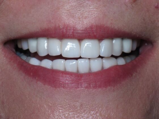 Cosmetic Crowns Cosmetic Crowns and Dental Implants for a Brighter Smile - After